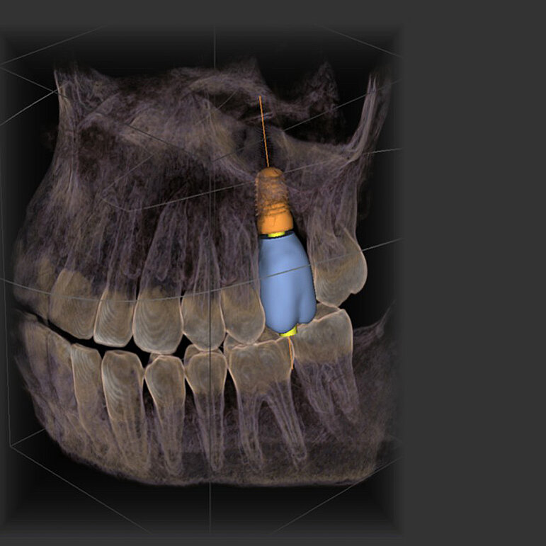 Implantat – Zahnarztpraxis Naturalsmile M. Wojtunik & Kollegen Pfronten